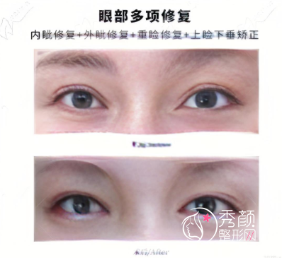 杜园园修复双眼皮水平怎么样？擅长高难度眼修复、医学背景深厚…