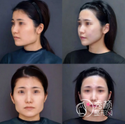 上海磨骨超有名的医生是