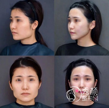 上海磨骨超有名的医生是谁？李志海、曹栋弼、李湘原…经验丰富