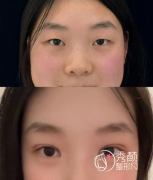 杭州割双眼皮哪个医生比