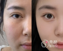 郑州修复双眼皮超好的医