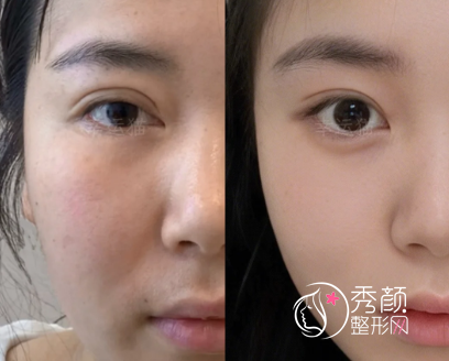 郑州修复双眼皮超好的医生是谁？贺洁、杨丽、杨小顺…技术优势各有不同