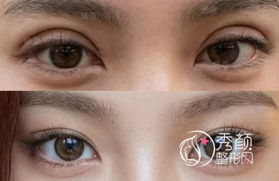 潘勇双眼皮修复怎么样？临床背景扎实、注重个性化设计…附医生简介