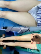 北京大腿吸脂医院排名：