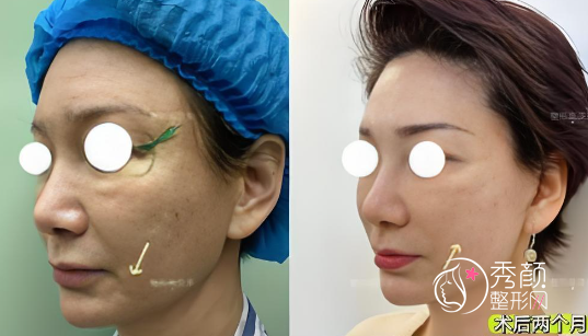 广州哪里做拉皮手术比较好？博仕、紫馨、曙光、海峡…术后年轻化程度高