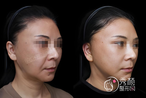 南京哪家整形医院做拉皮好？省人民医院、施尔美、康美、友谊…