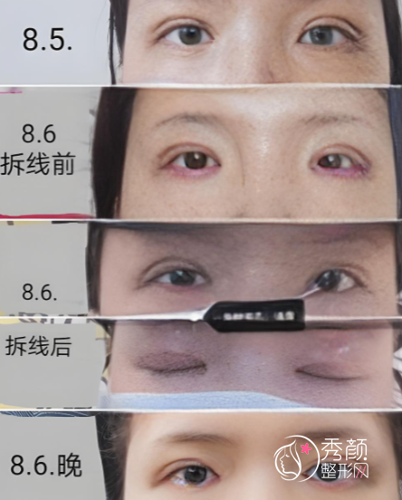 上海九院李华双眼皮做的怎么样？风格偏自然款、修复技术强、服务到位…