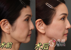 国内拉皮排名前十医生是