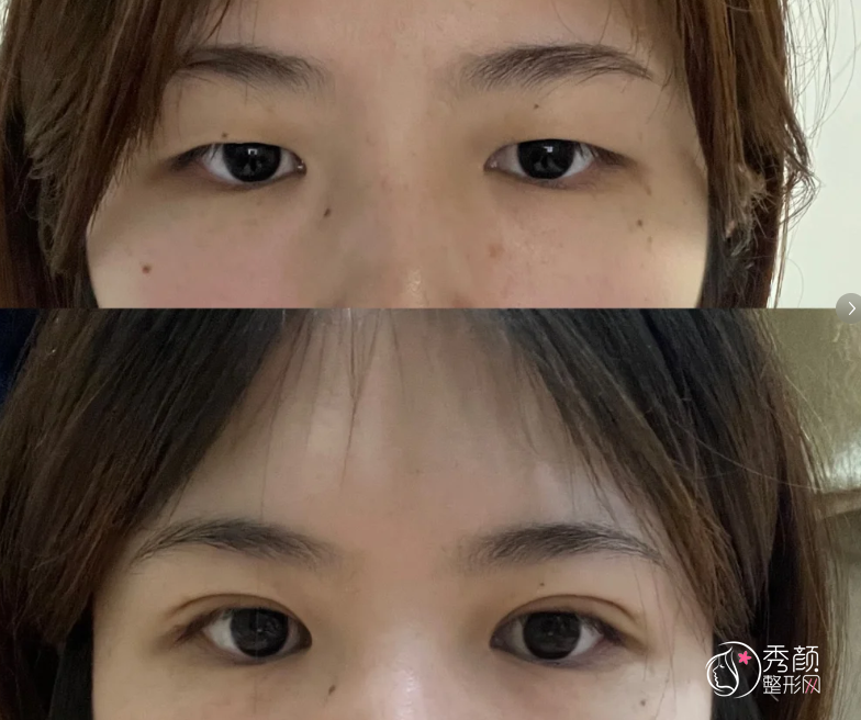 南阳杨中凯医生做双眼皮怎么样，有没有失败案例？