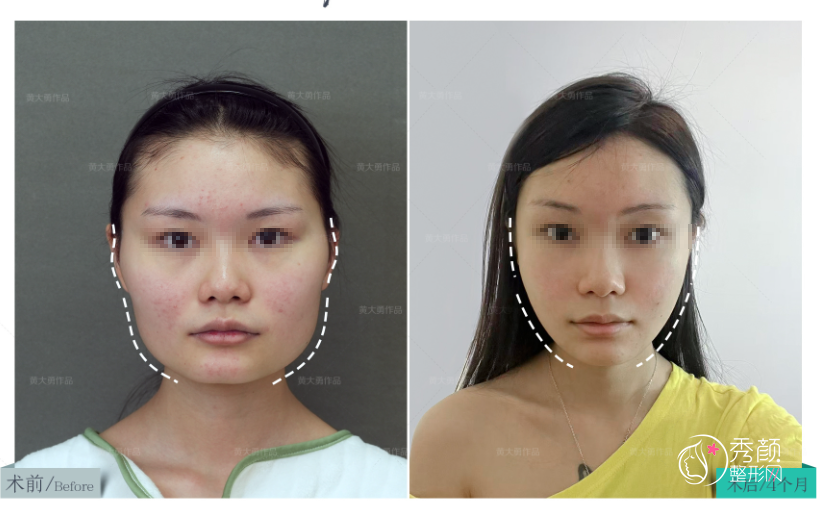 张笑天和黄大勇磨骨手术谁做的好？从技术特点、磨骨案例、费用等分析