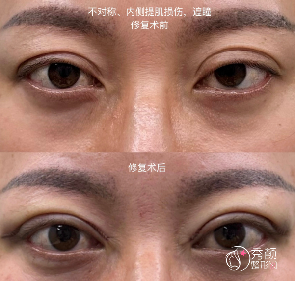 上海余东做双眼皮怎么样？坐诊机构上海时光整形外科医院,经验丰富