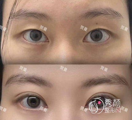 郑州眼王贺曼怎么样？双眼皮风格多样，价格透明...