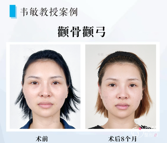 上海九院韦敏颧骨内推怎么样？颧骨内推费用25000元起，附颧骨内推案例