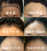 武汉靠谱的植发医院排名