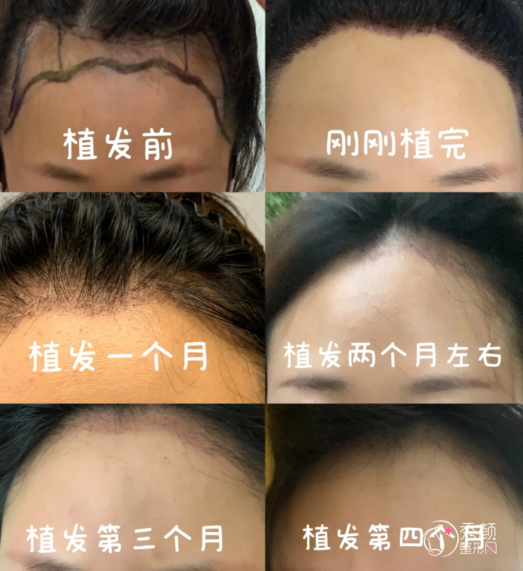 武汉靠谱的植发医院排名榜：省三人民医院、协和医院、碧莲盛植发、仁爱医院…植发技术很出众