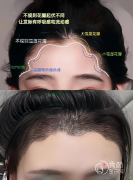 成都植发医院哪家好？省人民医院、西区医院、雍禾植发、碧莲盛植发…实力领