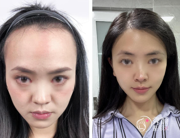 上海植发医院哪家好？九院、市皮肤医院、雍禾植发、大麦微针…人气很旺