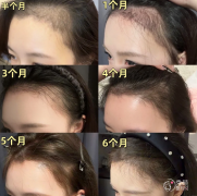 深圳植发医院哪个比较好？南方科技大学深圳医院、北京大学深圳医院、深圳鹏