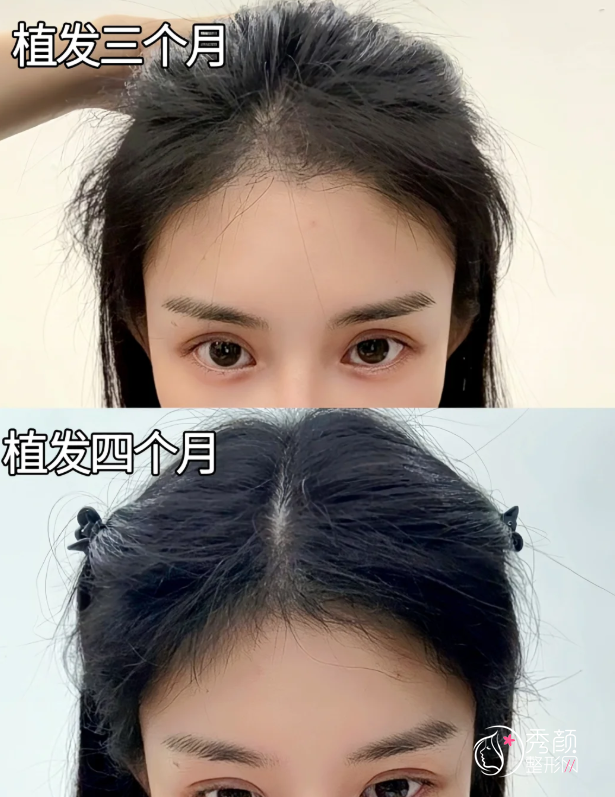 大连植发哪个医院好？新华医院、雍禾植发、碧莲盛植发…各有所长