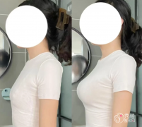 广州假体隆胸哪个医院做的好？南方医院、华美、丽合、荔湾区人民医院…