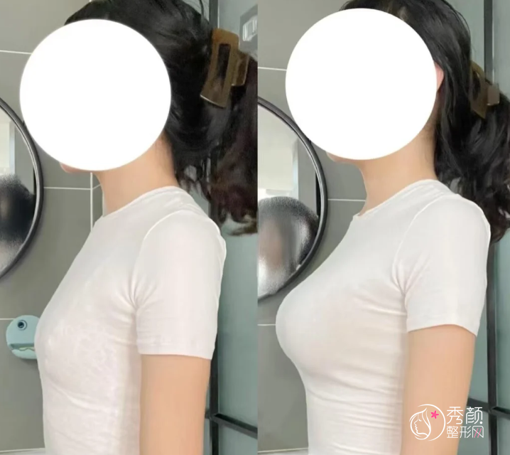 广州假体隆胸哪个医院做的好？南方医院、华美、丽合、荔湾区人民医院…