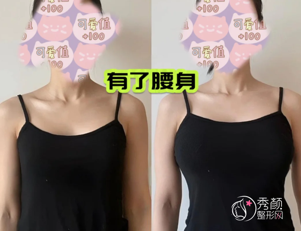 重庆自体脂肪丰胸哪个医院做的好？西南医院、铜雀台、新桥医院、松山医院…