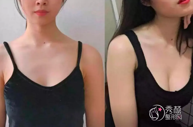 济南自体脂肪丰胸哪个医院做的好？市中心医院、诺德、艺星、爱容、韩氏…实力出众