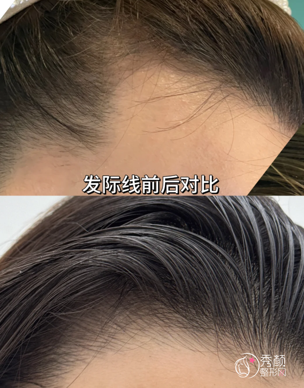 沈阳植发正规医院排名：盛京医院、沈阳医学院附属中心医院、雍禾植发…