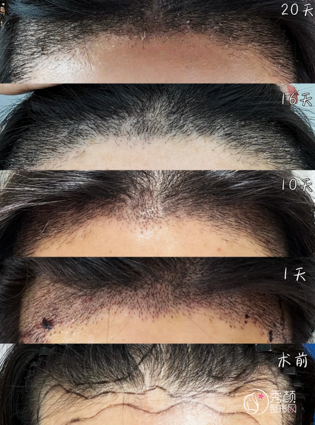 天津植发医院排名榜：天津医科大学总医院、雍禾植发、熙朵植发…名列前茅