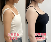 北京假体隆胸哪个医院做