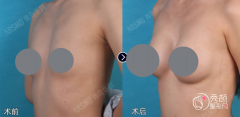 青岛自体脂肪丰胸哪个医