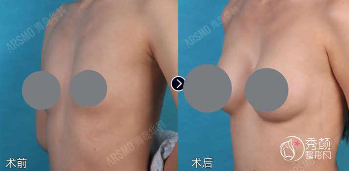 青岛自体脂肪丰胸哪个医院做的好？青岛大学附属医院、市立医院、华颜美…实力出众