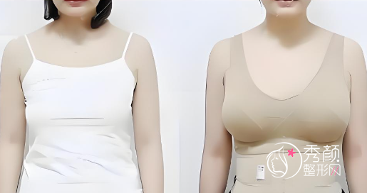 长沙自体脂肪丰胸哪个医院做的好？湘雅医院、鹏爱、雅美、爱思特…