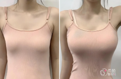 成都假体隆胸哪个医院做