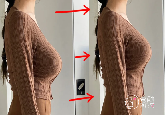 武汉假体隆胸哪个医院做的好？武汉大学人民医院、同济医院、协和医院…实力在线