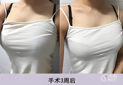 长沙假体隆胸哪个医院做