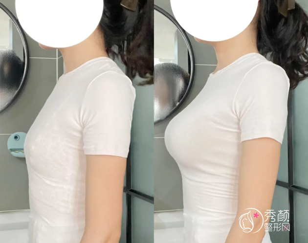 青岛假体隆胸哪个医院做的好？青岛大学附属医院、诺德、华韩…均是网友推荐的实力机构