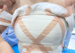 昆明自体脂肪丰胸哪个医