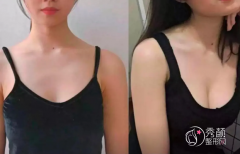 苏州自体脂肪丰胸哪个医