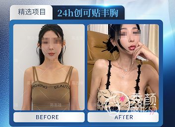 天津假体隆胸哪个医院做的好？医科大总医院、天津医院、美莱、伊美尔…专业度高