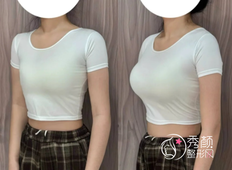 厦门假体隆胸哪个医院做的好？厦大附一院、修志夫、薇格、翔安…实力强