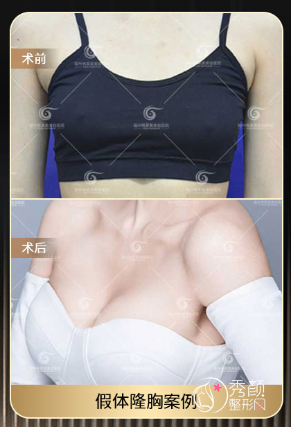 福州假体隆胸哪个医院做的好？福医大附一院、省立医院、海峡医美、爱美尔…