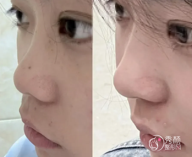 一支嗗科拉等于6支宝尼达？最强骨性填充再生材料嗗科拉是智商税吗？