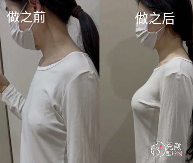 南昌自体脂肪丰胸哪个医院做的好？南昌大学一附院、省人民医院、佳美、韩美…