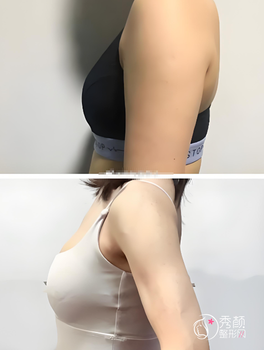 厦门自体脂肪丰胸哪个医院做的好？厦门大学附一院、欧菲、华美、海峡…实力强