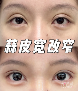 八大处卢建建和王太玲谁修复双眼皮好？从医学背景、技术优势、术后