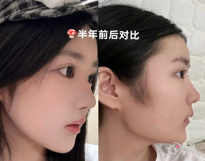 北京八大处张智勇和上海九院韦敏哪个做磨骨手术好一点？