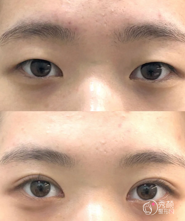 北京协和医院白明和黄久佐谁做双眼皮好看？两位人气眼整形专家技术比拼