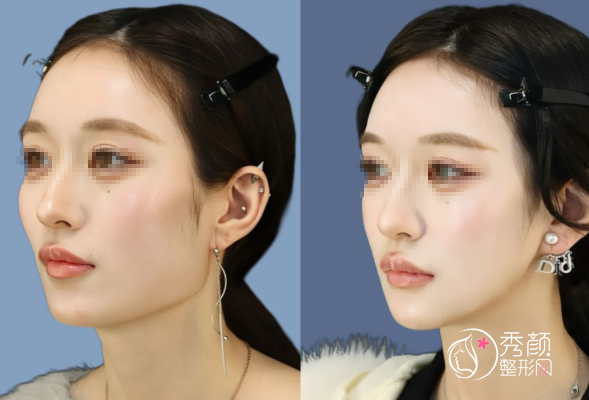 上海磨骨穆雄铮和韦敏哪个厉害？两大实力整形外科专家技术对比