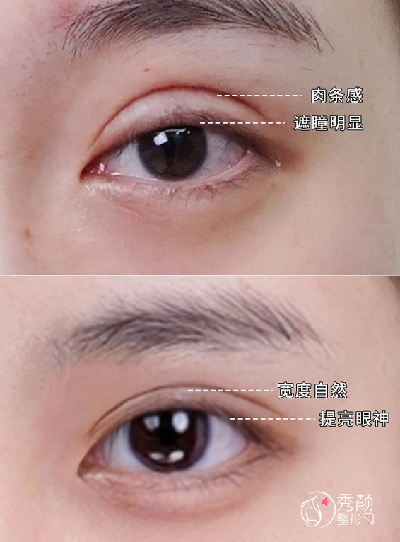 2026全国双眼皮修复手术特别好的医生是谁？十大修复医生盘点